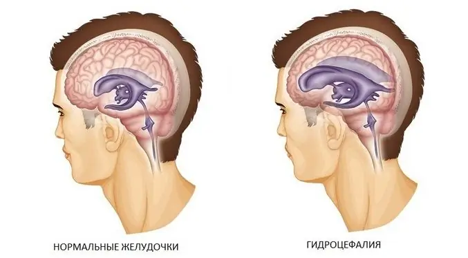 Gesund und mit Hydrozephalus