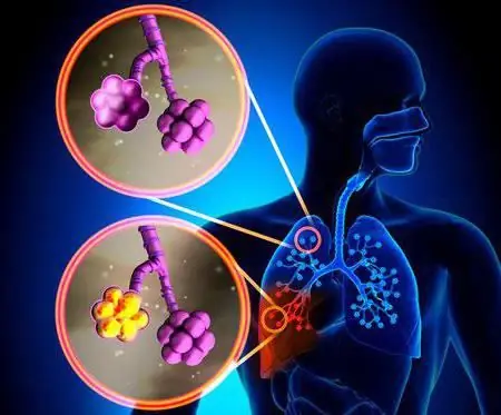 pneumonie sans symptômes