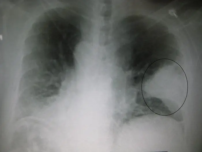 diagnostic et traitement de la pneumonie