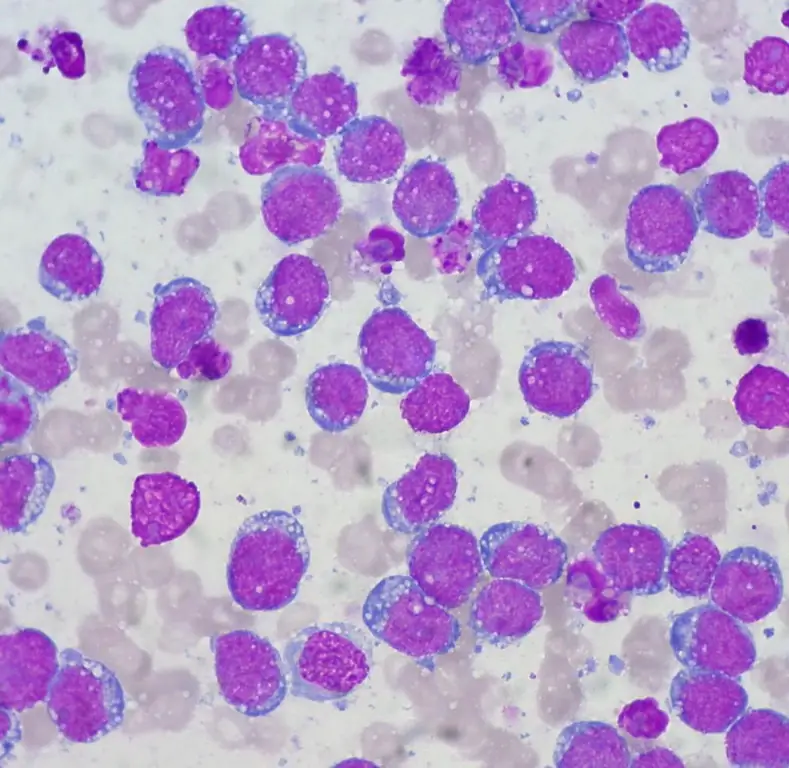 diffuse inlarge cell lymphoma