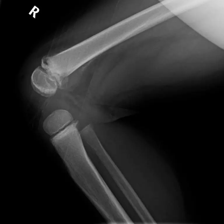 diffuse loj cell non-Hodgkin's lymphoma prognosis