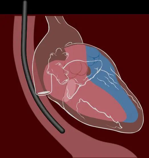 échocardiographie transoesophagienne