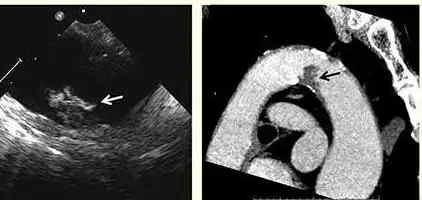 qu'est-ce que l'échocardiographie transoesophagienne