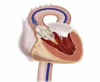 transesophageal echocardiography ምልክቶች