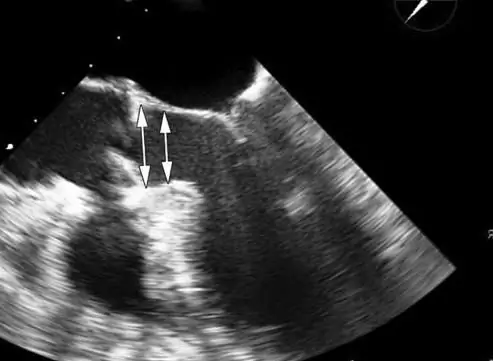 transesophageal echocardiography review ng mga doktor