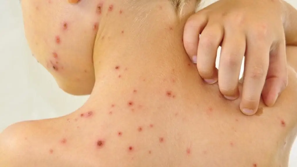 Herpes: terining namoyon bo'lishi