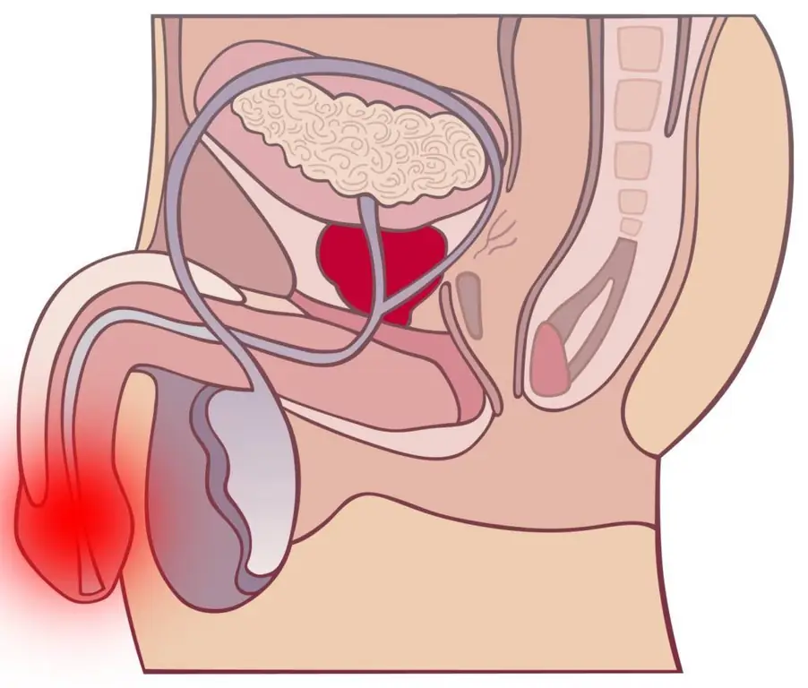 pain during urination in men