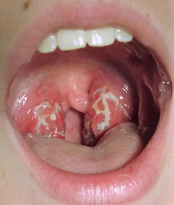 Abscesses on the tonsils without fever