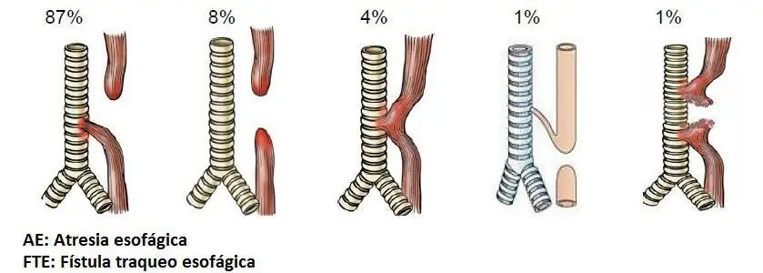 Bất thường của thực quản