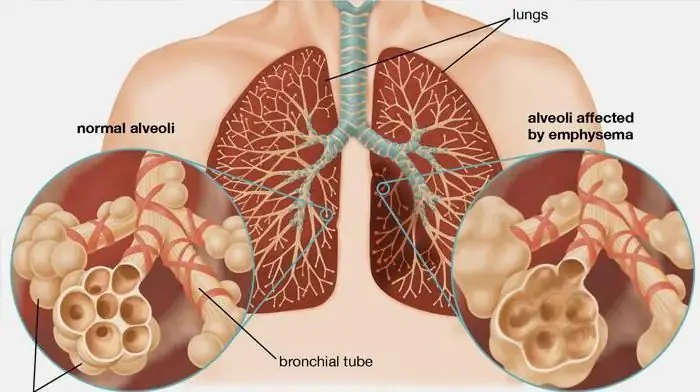 triệu chứng và điều trị viêm phế quản tắc nghẽn ở người lớn