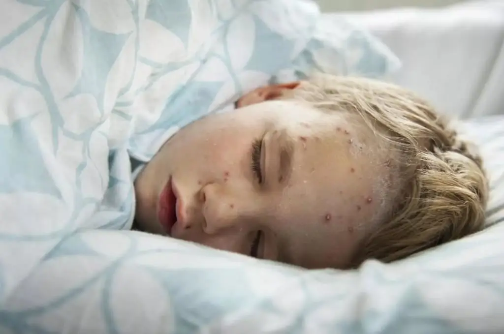 Chicken pox in children