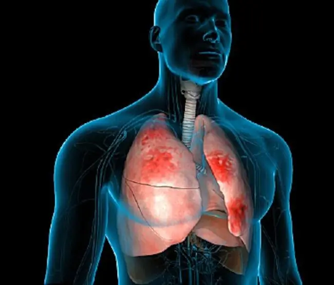 pneumonia total