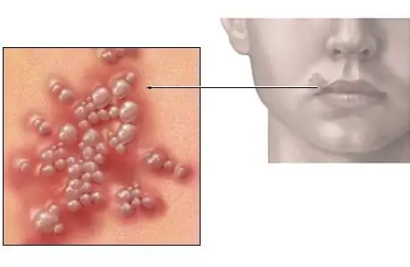 how to get rid of herpes on lips