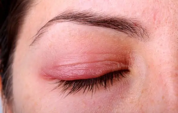 Upper eyelid