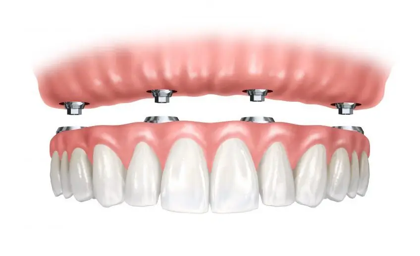 complete denture