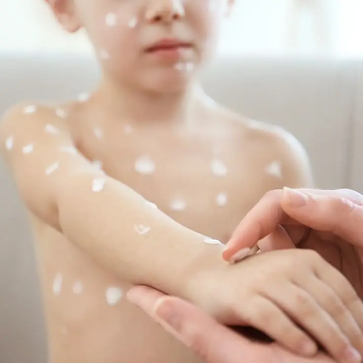 chickenpox treatment