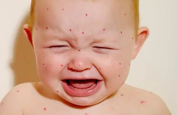 chickenpox in a baby