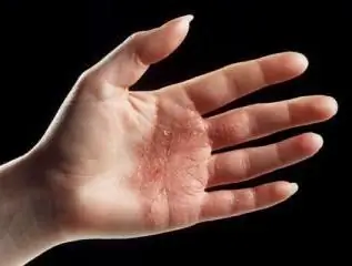 behandeling van handdermatitis