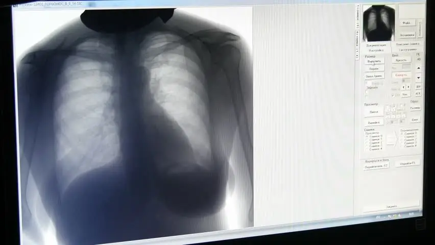 Will fluorography show pneumonia inflammation