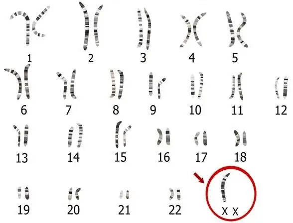 Karyotype in Turner syndrome