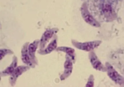 toxoplasmosis positive