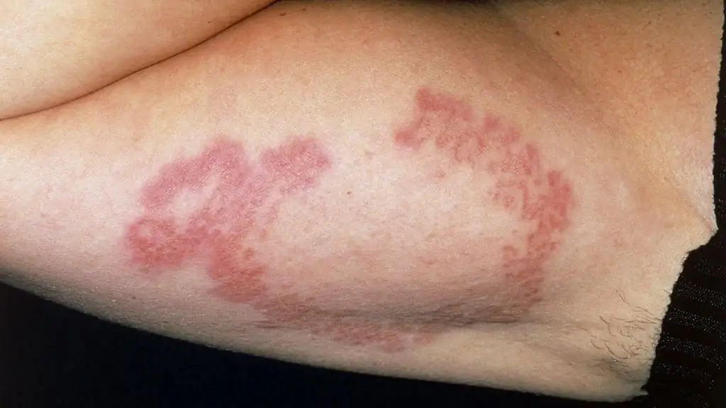 causes of fungus under the arms