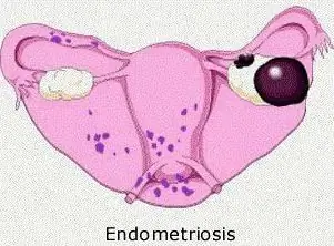 o'ng tuxumdon kistasiendometrioid