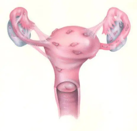 Endometrioidzyste des rechten Eierstocks