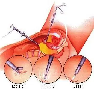 endometrioid cyst ng kanang ovary na larawan