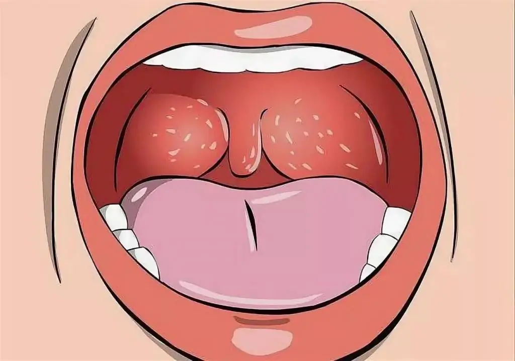 Throat lesion