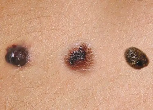 Where to check a mole for oncology ways