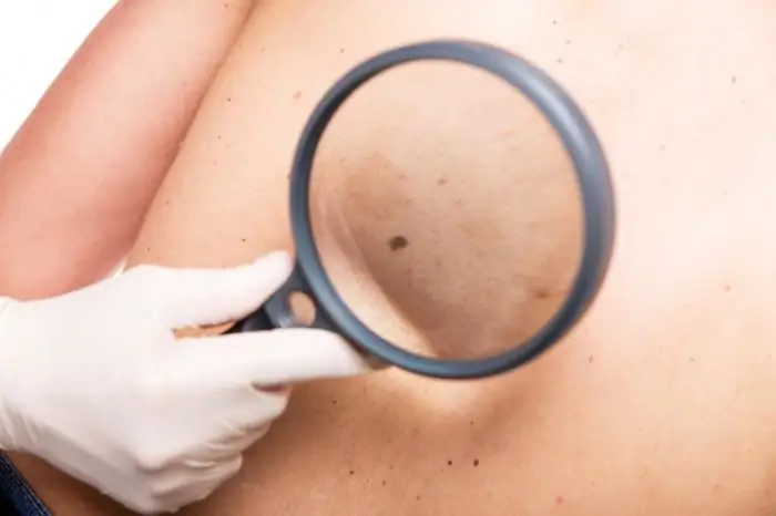 Which doctor checks moles