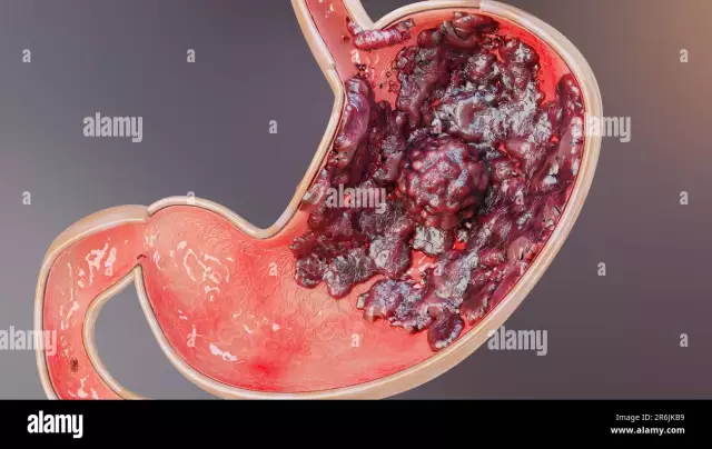 Lenfogranülomatozis - kanser mi değil mi? Hodgkin hastalığı - malign bir lenfoid doku hastalığı: semptomlar, tedavi, tanı, prognoz