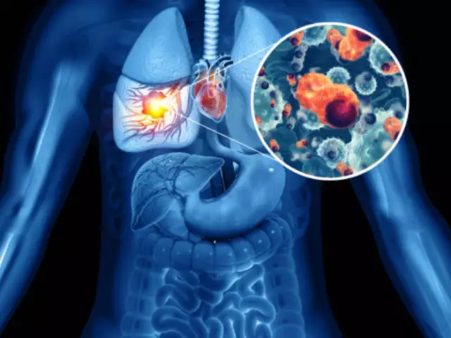 Lung cancer: the first symptoms. How not to miss?