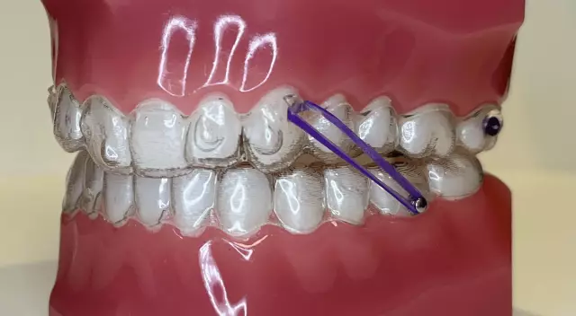 Correction of bite in adults: methods, age and timing