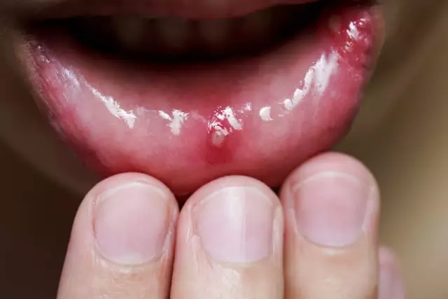 Stomatitis: symptoms and treatment, photo, prevention