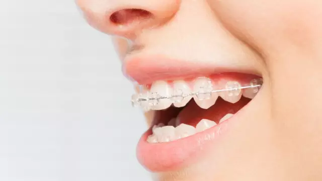 Ceramic braces: description, photos, reviews, pros and cons