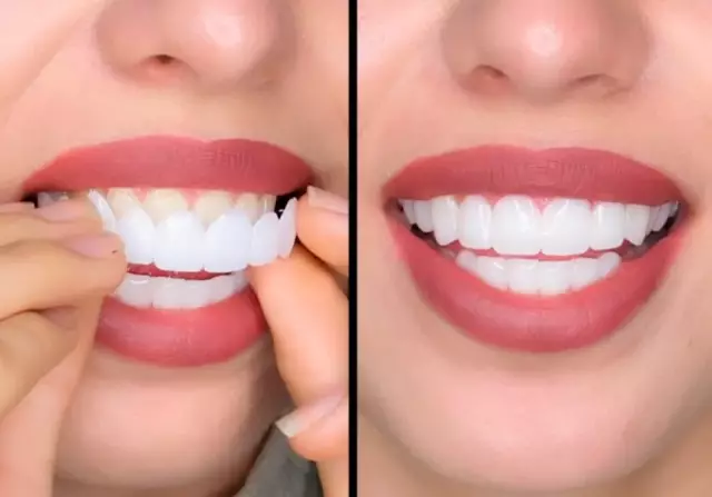 Veneers: reviews, recommendations for use