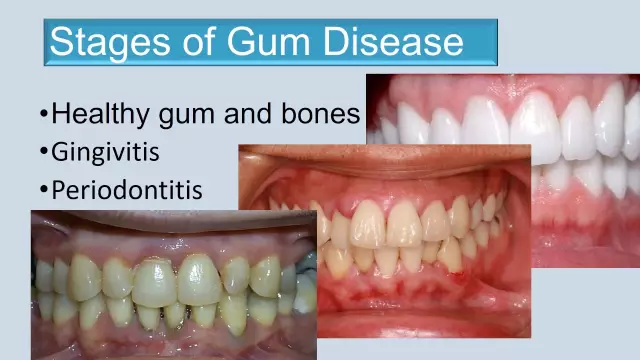 How is periodontal disease treated in the initial stages of the disease