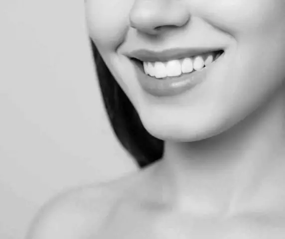 Composite veneers give a luxurious smile