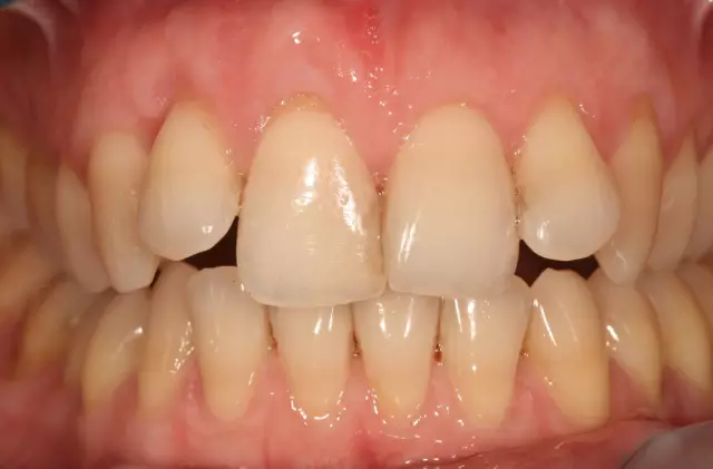 Receding gums: treatment, photo