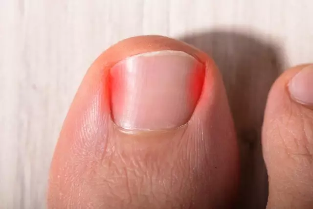 Quite a common occurrence - ingrown toenails. What to do in this case?