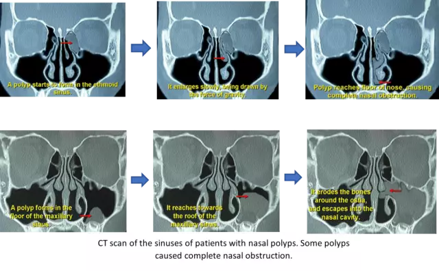 Nose growth: causes and methods of removal. Nasal polyps: treatment without surgery