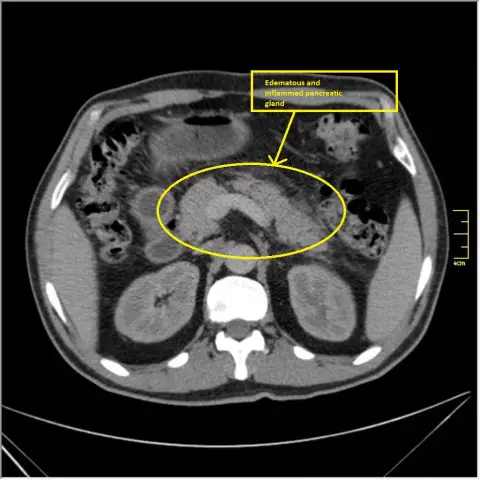 Symptom of Resurrection and other signs of acute pancreatitis