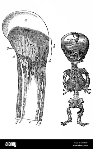 Causes and signs of rickets in a child