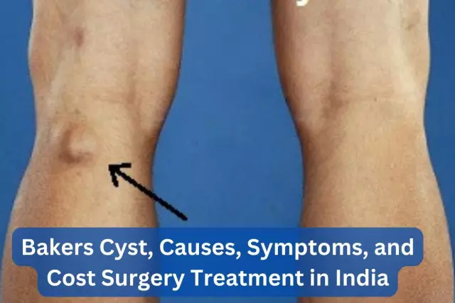 Synovial cyst: causes and treatment