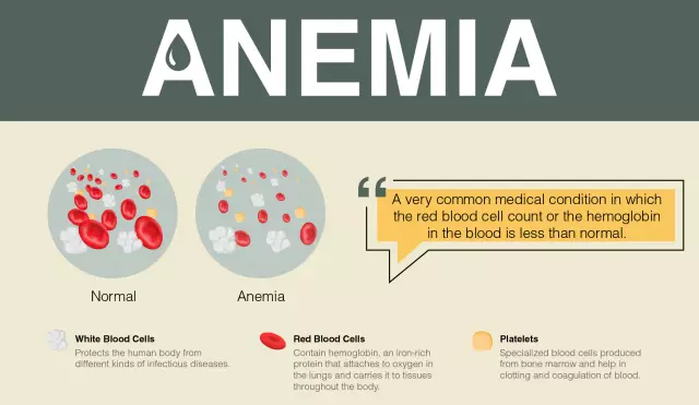 Anemia em gestantes: possíveis causas, sintomas, características de prevenção e tratamento