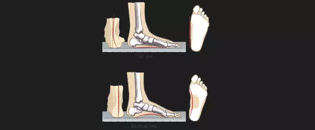 Pieds plats. Raisons du développement. Prévention des pieds plats