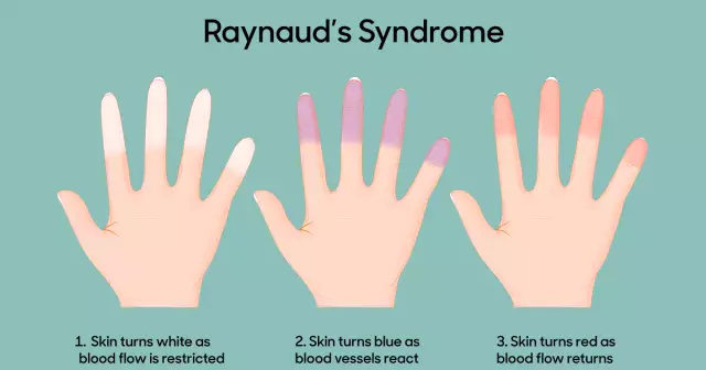 Mendelssohn's syndrome: symptoms, treatment, prevention