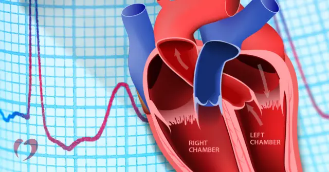 Heart block - ano ito? Mga sanhi, sintomas at paggamot ng heart block